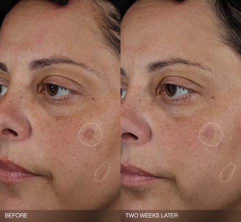 Faded Dark Spot Patches