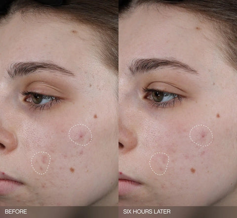Faded Dark Spot Patches