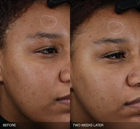 Faded Dark Spot Patches
